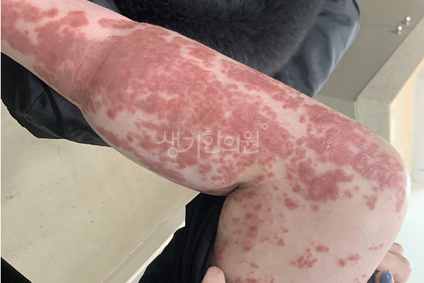 건선 사례 치료 전 생기한의원 건선 치료 전 증상 사진